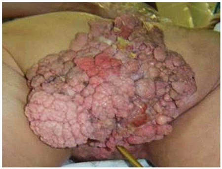 Kutil Kelamin Pada Anus Kutil Kelamin Pada Anus