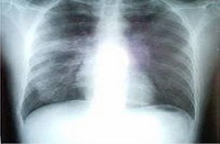 الأمراض التي تصيب الجهاز التنفسي - الموسوعة المدرسية