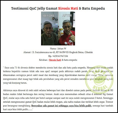 https://4.bp.blogspot.com/-DGK3dYaLDqM/Wm6O4o3qScI/AAAAAAAAAiM/OzOCc7zB7lgJpi5BhK1NzVxYaJSDOdwdACLcBGAs/s1600/sirosisss.jpg