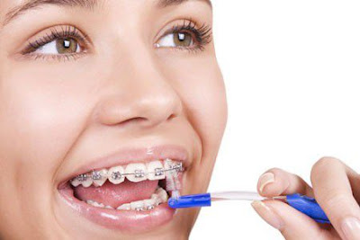 Ưu điểm của phương pháp niềng răng