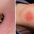 How to Recognize Infected Tick Bites and What You Should Do Immediately