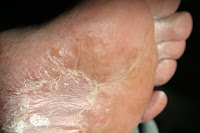 Cara menghilangkan gatal di kaki yang sudah menahun Cara menghilangkan gatal di kaki yang sudah menahun