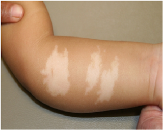 Hypopigmentation caused due to use of corticosteroids.