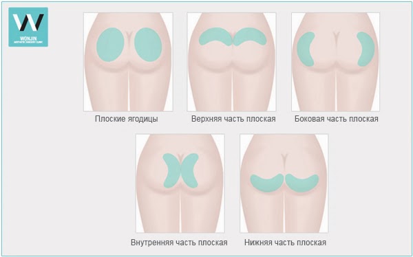 Подтяжка ягодиц тейпами схема