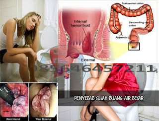 Lubang Pantat Suka Keluar Darah Gejala Apa Lubang Pantat Suka Keluar Darah Gejala Apa
