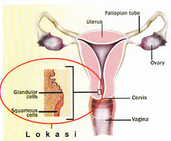 Foto Obat Kanker Serviks Manjur