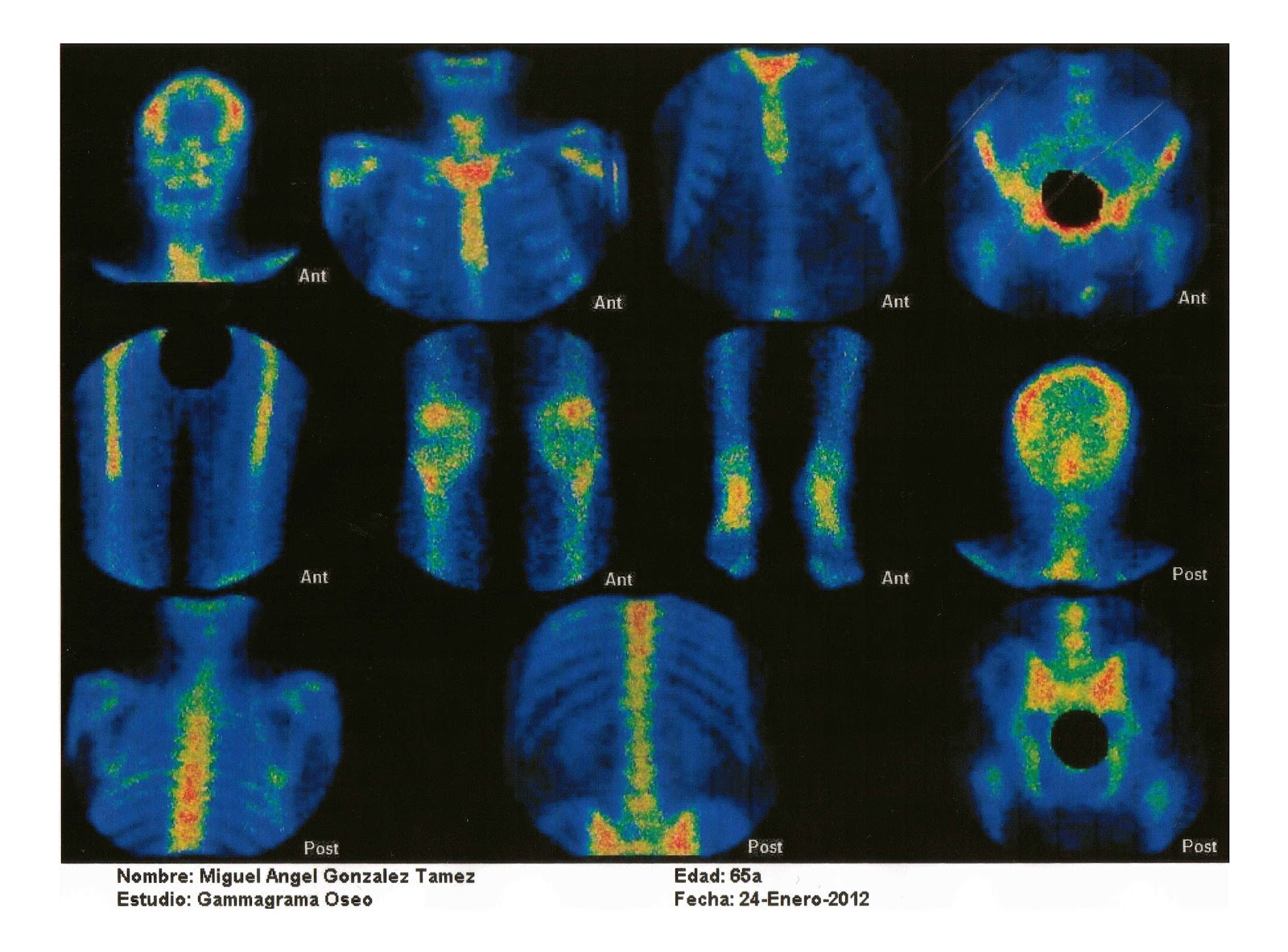 Hemangioma of Infancy (HI) Picture Image on MedicineNet.com