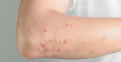 El medicina zoster para controlar natural herpes