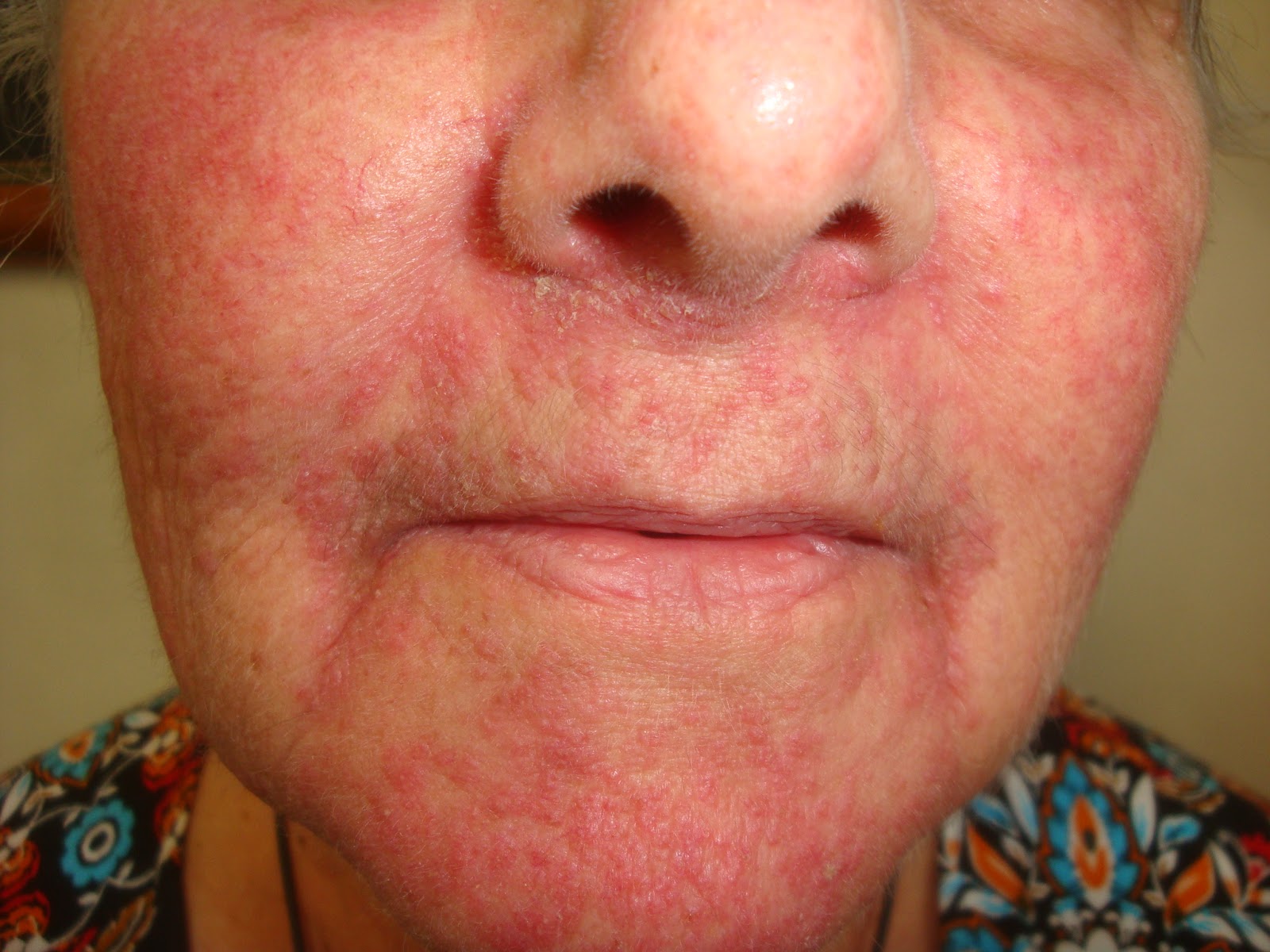 consultations-in-dermatology-rosacea-steroid-induced-video
