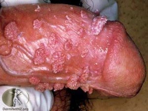 condyloma pénisz a méhnyak lapos condyloma diszpláziával