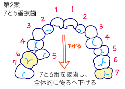 歯科矯正のイラスト　©さんがつの歯科矯正を始めます