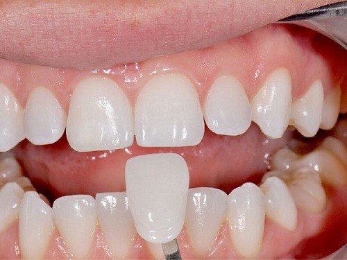 RĂNG SỨ CÓ THAY THẾ RĂNG THẬT ĐƯỢC KHÔNG -3