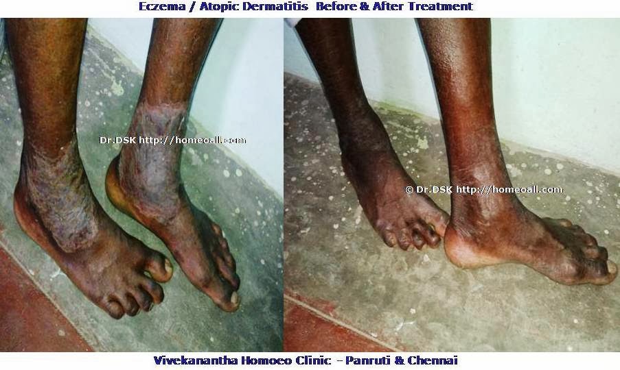 HomeoallAtopic dermatitis-Eczema Homeopathy Treatment ...