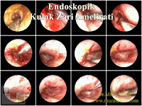 Endoskopik Kulak Zarı Ameliyatı - Endoskopik Miringoplasti - Endoskopik Kulak Zarı Tamiri - Endoskopik Miringoplasti - Transkanal Endoskopik Miringoplasti - Endoskopik Kulak Zarı Operasyonu - Transcanal Endoscopic Myringoplasty - Endoscope Assisted Myringoplasty, Endoscopic Myringoplasty - Endoscopic-Assisted Myringoplasty - Endoscopic Eardrum Hole Surgery - Endoscopic Repair of Tympanic Membrane Perforation
