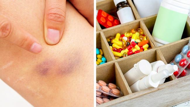 Các vết bầm tím xuất hiện trên da không rõ nguyên nhân báo hiệu bệnh Các vết bầm tím xuất hiện trên da không rõ nguyên nhân báo hiệu bệnh