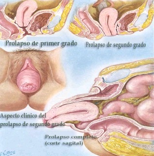prolapso uterino tratamento natural