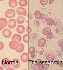 Informasi Seputar Penyakit Thalasemia Informasi Seputar Penyakit Thalasemia