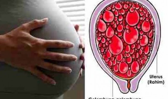 Waspadai Penyakit Mola Hidatidosa yang Sebabkan Bayi Cacat Lahir Bahkan Meninggal Dalam Kandungan Waspadai Penyakit Mola Hidatidosa yang Sebabkan Bayi Cacat Lahir Bahkan Meninggal Dalam Kandungan