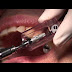 This New Dental Sinus Lift Technology Is Definitely A Hit