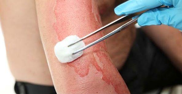 Home Remedies For Burns, Burns Treatment, Burns Home Remedies, Minor Burns, How To Treat Burns, How To Cure Burns, Burns Remedies, Remedies For Burns, Home Remedies For Minor Burns, Cure Burns, Treatment For Burns, Best Burns Treatment, Burns Relief, How To Get Relief From Burns, Relief From Burns, How To Get Rid Of Burns Fast,