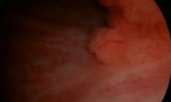 Le most cancers Du Pancreas Est Il Hereditaire