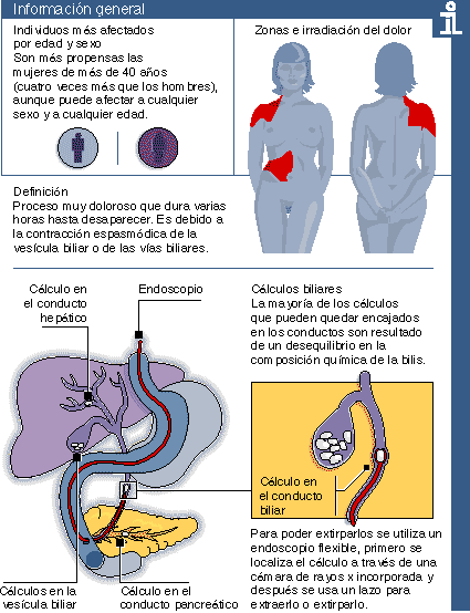 Colico biliar tratamiento dieta Colico biliar tratamiento dieta