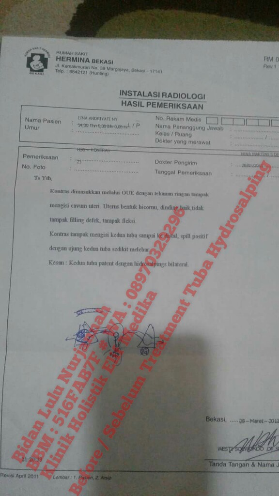 Before : Kedua Tuba Paten Namun Terdapat Hidrosalping Bilateral Before : Kedua Tuba Paten Namun Terdapat Hidrosalping Bilateral
