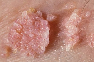 Nama Obat Alami Untuk Kutil di Batang Penis