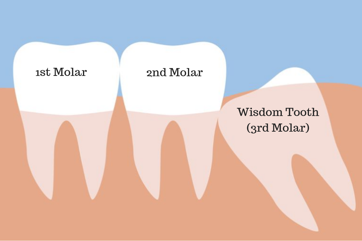 Do i need to remove my wisdom teeth 