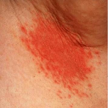Bệnh viêm kẽ Bệnh viêm kẽ