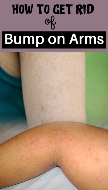 How To Get Rid Of Bumps On Arms Top 5 Diy
