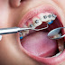 Niềng 4 răng cửa áp dụng cho những tình trạng như thế nào?