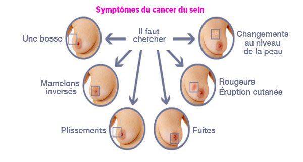 type de cancer du sein type de cancer du sein
