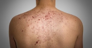 Acne En La Espalda Acne En La Espalda