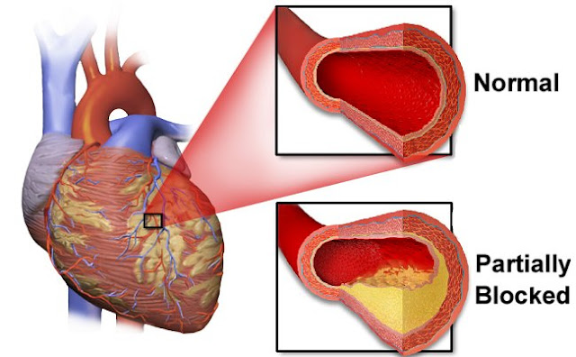Definisi, Gejala, dan Pengobatan Penyakit Jantung Koroner