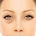 10 Best Natural Tips to Cure Eyes Puffiness or Under Eye Bags