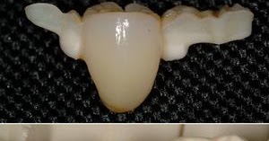 Puente Maryland en odontología | Odontología al Dia