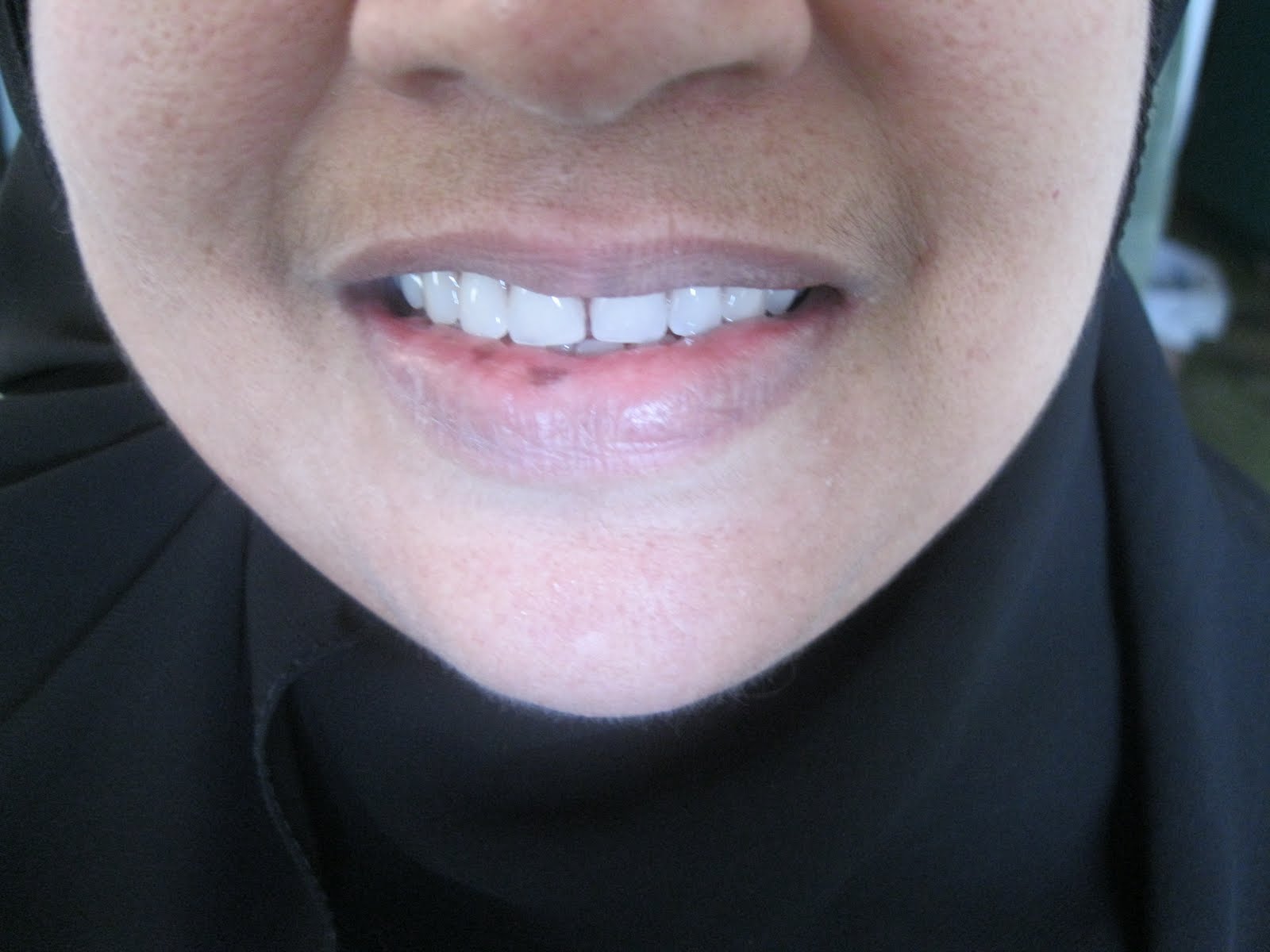 DENTO CARE DENTAL CLINICS Complete Denture