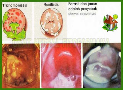 Image Result For Cara Menyembuhkan Jamur Image Result For Cara Menyembuhkan Jamur