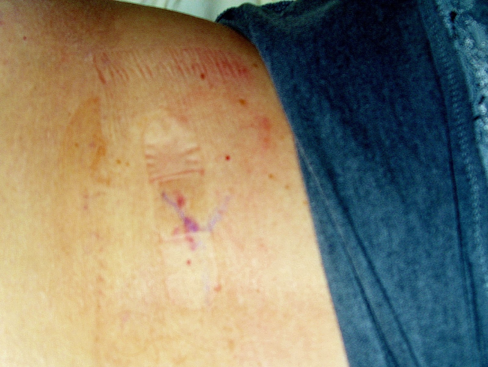 Rocquie's Lymphoma CT Guided Core Needle Biopsy