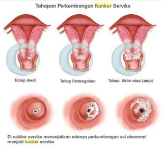 Pengobatan Tradisional Kanker Serviks, Jual Obat Alami Kanker Serviks Stadium 3, Obat Kanker Serviks Stadium 4