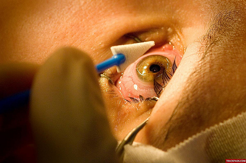 LASIC What You Should Know About LASIK What Is LASIK?