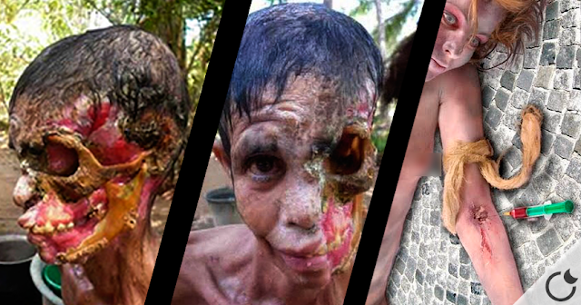 Imagenes Fuertes De La Droga Krokodil | almanaque bristol top 10 drogas m 193 s peligrosas video Imagenes Fuertes De La Droga Krokodil | almanaque bristol top 10 drogas m 193 s peligrosas video