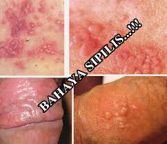Apa Obat Penyakit Sipilis Kronis Apa Obat Penyakit Sipilis Kronis