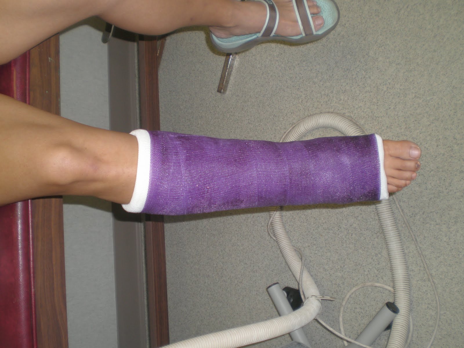 prigizmo's Achilles Tendon Injury Recovery June 11 Achilles Tendon