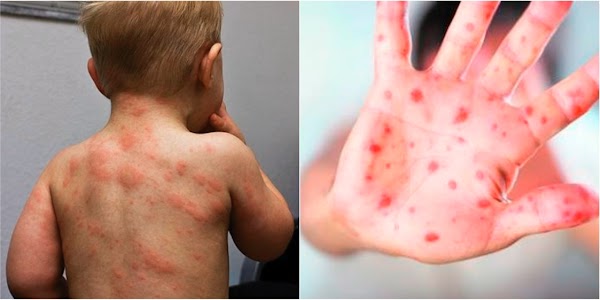 Unicef alerta sobre oleada mundial de casos de sarampión. Unicef alerta sobre oleada mundial de casos de sarampión.