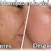REMEDIOS CASEROS PARA LAS MANCHAS