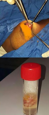 h Nigerian doctor shares photos from a breast lump removal on Instagram
