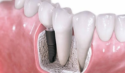 Cấy ghép implant mất bao lâu thì hoàn thiện