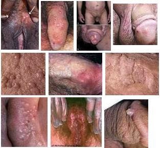 Obat Sipilis Di Kota Besar Indonesia